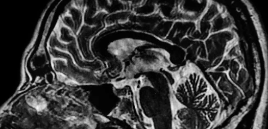 x-ray of brain 