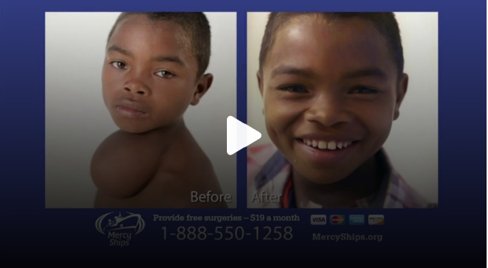 Before and after photo of a child with a birth defect